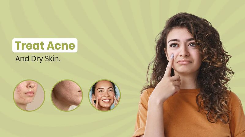 How to Treat Acne on Dry Skin: 9 Effective Tips for Healthier Skin