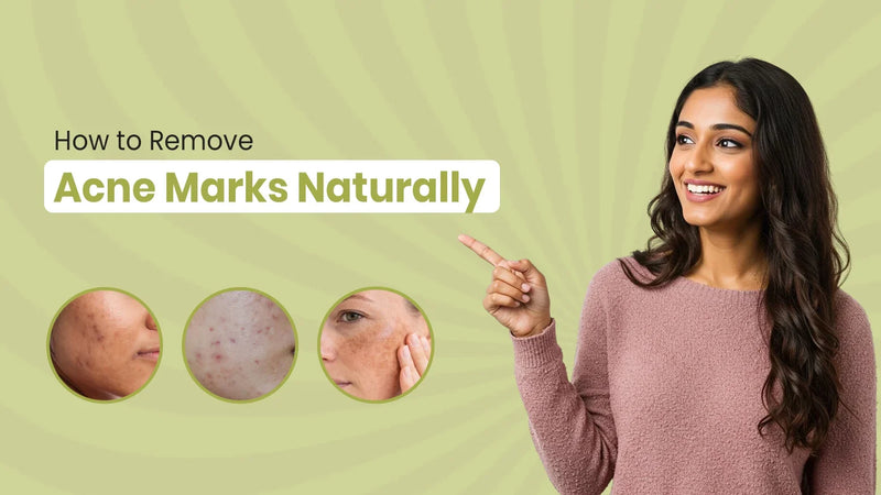 How to Remove Acne Marks Naturally: A Practical Guide to Clearer, Even-Toned Skin