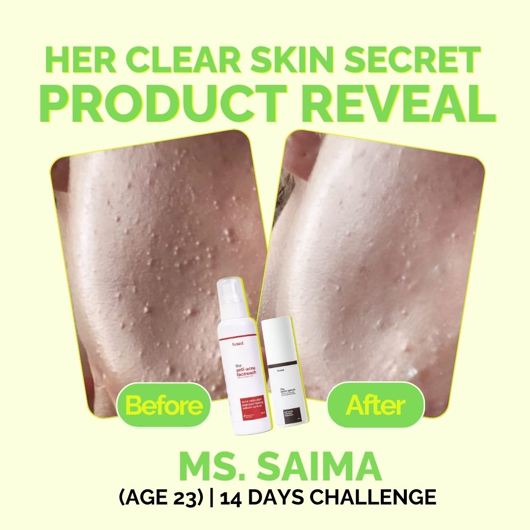 Fused Anti Acne Facewash before and after 14 days skin acne reduction results
