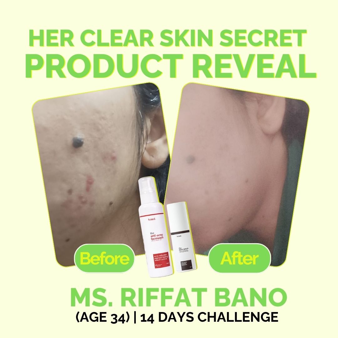 Fused Anti Acne Facewash before and after 14 days skin acne reduction results