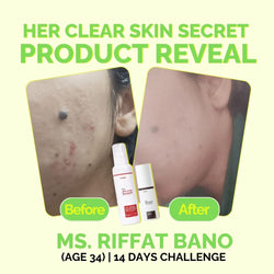 Fused Anti Acne Facewash before and after 14 days skin acne reduction results