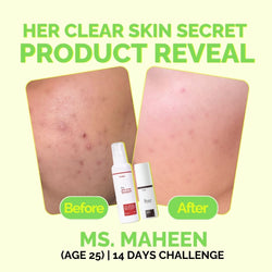 Fused Anti Acne Facewash before and after 14 days skin acne reduction results